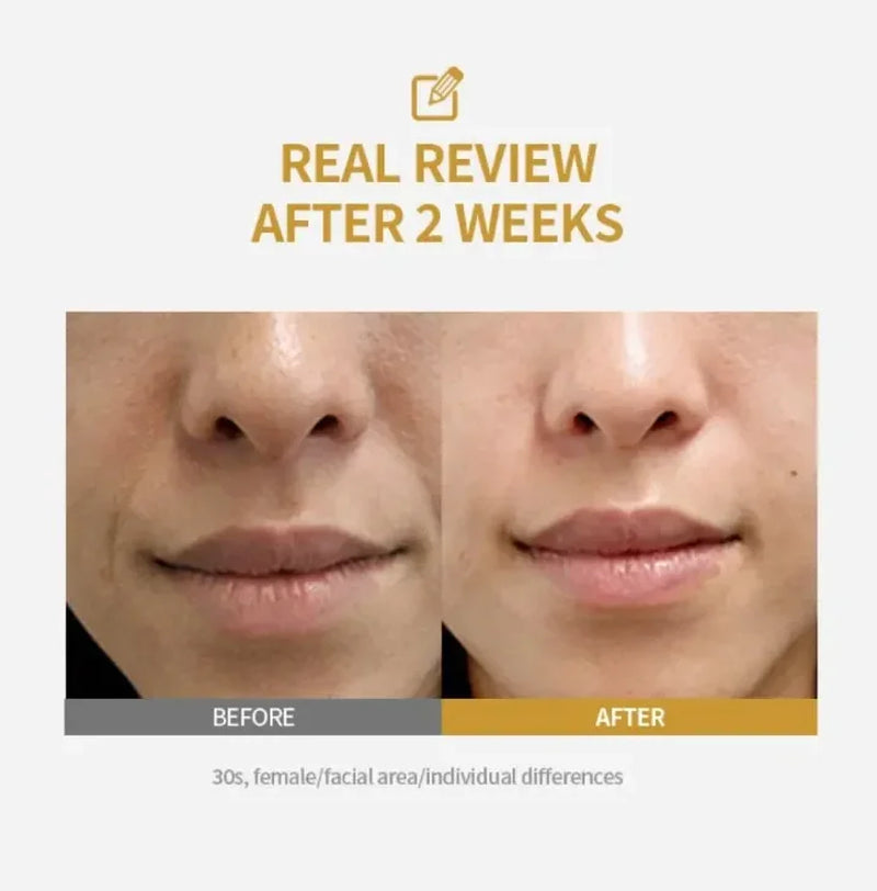 Kojic Acid Niacinamide Whitening Serum Dark Spot Remover Brightening Cream Freckle Mask Fade Acne Scars Melasma Dull Skin